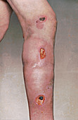 Ulcerated leg