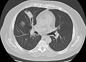 Adenocarcinoma of the lung, CT scan