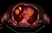 Adenocarcinoma of the lung, PET CT scan