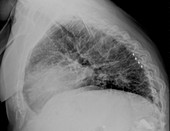 Bronchiectasis, X-ray