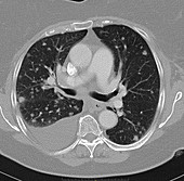 Diffuse pulmonary metastases, CT scan