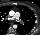 Pulmonary thromboembolism, CT angiogram