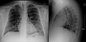 Viral pneumonia, chest X-ray