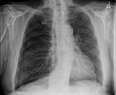 Tension pneumothorax, X-ray