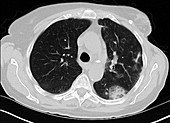 Eosinophilic pneumonia, CT scan