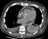 Hemothorax post cardiac surgery, CT scan