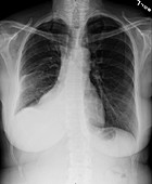 Pleural effusion, X-ray