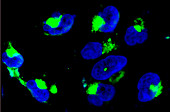 Nanoparticles in glioma cancer cells, light micrograph