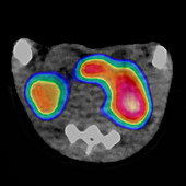 Nanoclusters in breast cancer, PET-CT scan
