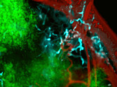 Nanosensors in breast cancer, light micrograph