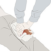 Direct compression of wound, illustration