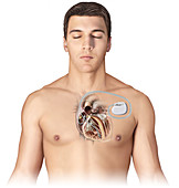 Artificial Pacemaker, illustration