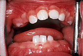 Primary Teeth, 18 Months
