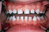 Child with Spaces Between Teeth