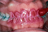 Dental Plaque, Red Disclosing Dye