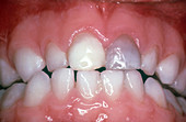 Discolouration of Teeth after Trauma