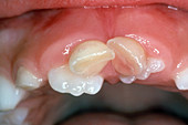 Over-Retained Primary Central Incisors
