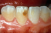Tooth Discolouration from Previous Trauma