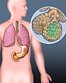 Cystic fibrosis, illustration