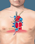 Transplant recipient heart removal, illustration