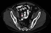 Carcinoid, axial CT scan