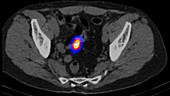 Carcinoid, axial CT scan
