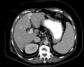 Cirrhosis, axial CT scan