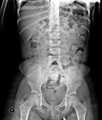 Constipation in 5-year-old, X-ray