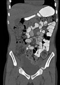 Constipation in 12-year-old, CT scan