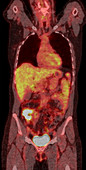 Colon carcinoma, PET-CT scan