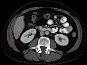 Liver metastases, CT scan