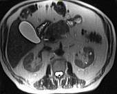 Pancreatitis, MRI