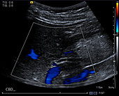Normal hepatic duct, ultrasound