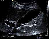 Normal gallbladder, ultrasound