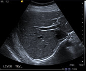 Normal liver, ultrasound