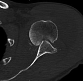 Anterior glenohumeral subluxation, CT scan