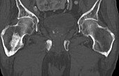 Prostate metastasis, CT scan