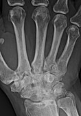 Rheumatoid arthritis, X-ray