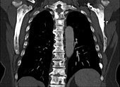 Metastases in spine, CT scan