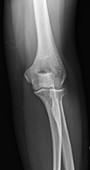 Normal elbow, X-ray