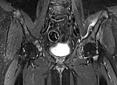 Metastases in hip, MRI