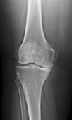 Osteoarthritis, X-ray