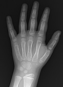 Child's hand, normal, X-ray