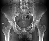 Normal pelvis, X-ray
