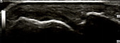 Pannus in metacarpal phalangeal joint, ultrasound