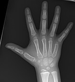 Normal hand of child, X-ray