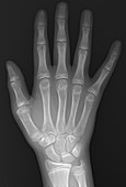 Normal hand of 13 year old, X-ray
