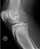 Salter-Harris fracture, X-ray