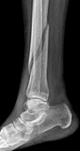 Tibia fracture, X-ray