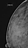 Breast cancer, mammogram